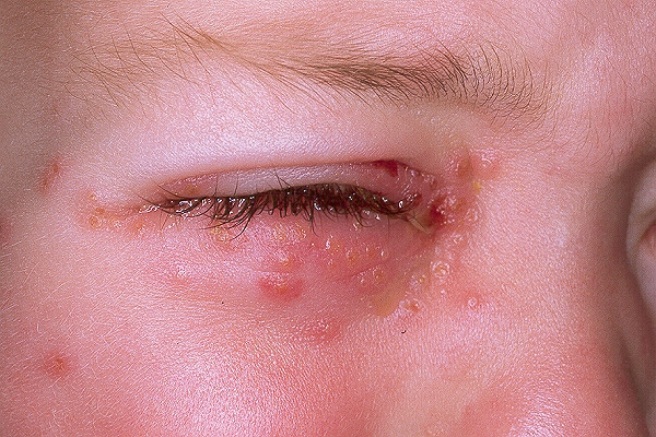 Краевой (лимбальный) кератит глаза: симптомы, причины, лечение и профилактика