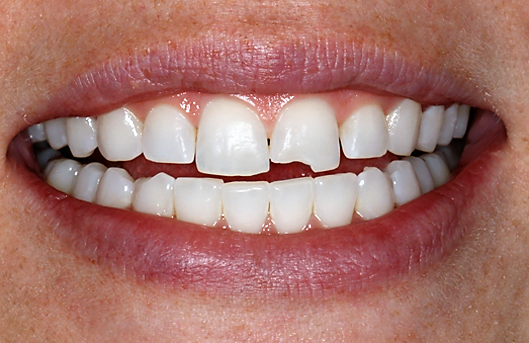 Почему крошатся зубы у взрослого человека: причины и лечение
