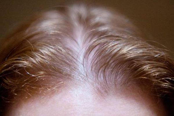 каким бывает диффузное выпадение волос у женщин