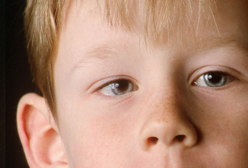 Амблиопия (ленивый глаз): симптомы и причины появления