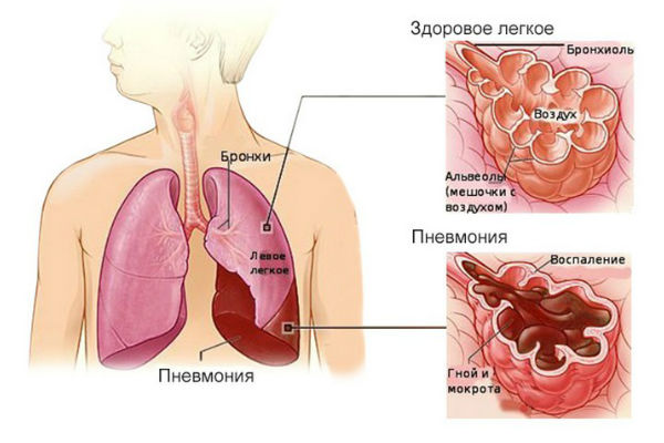 Пневмония у взрослых. Симптомы и лечение в домашних условиях