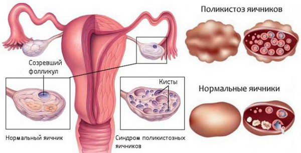 Поликистоз яичников - одна из причин почему может быть задержка месячных кроме беременности