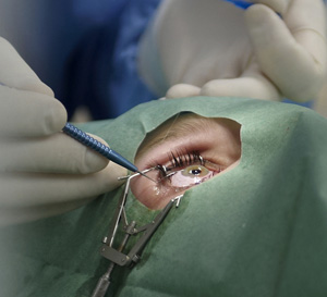 Конкретный вид коррекции подбирает офтальмохирург