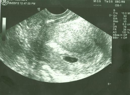 УЗИ на 4-й недели беременности