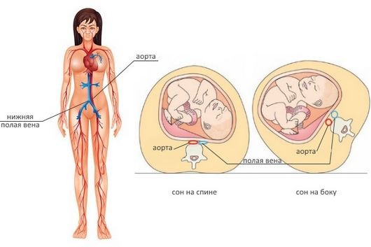 Сон на левом боку снижает отеки при беременности
