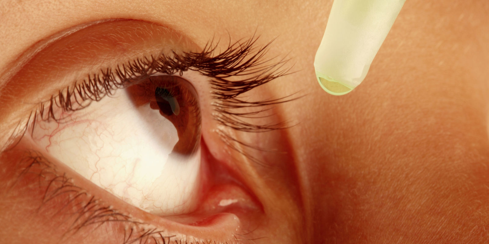 Поверхностный кератит глаза: симптомы и лечение