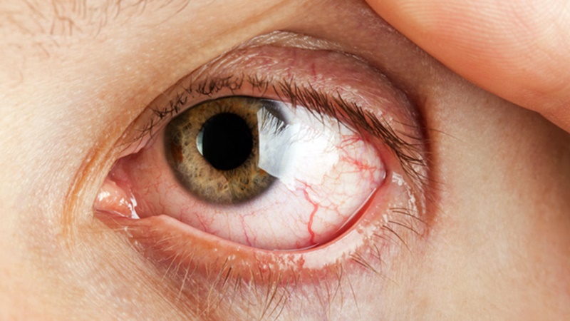Травматический кератит глаза: виды, симптомы, осложнения