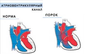 Атриовентрикулярный канал врожденный порок сердца у новорожденных