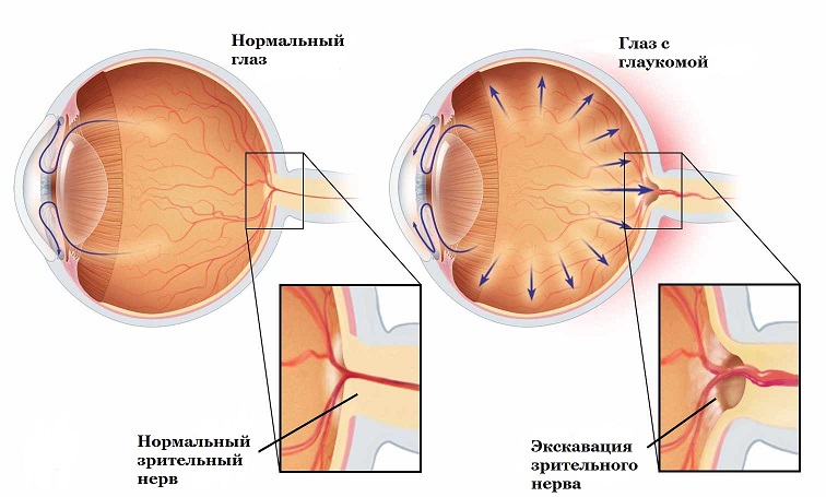 Разница между здоровым глазом и глазом с глаукомой 
