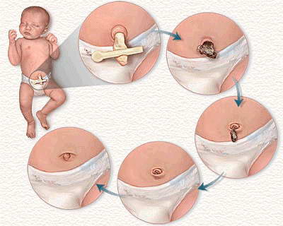 Этапы заживления пупка у новорожденного